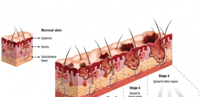سرطان الجلد