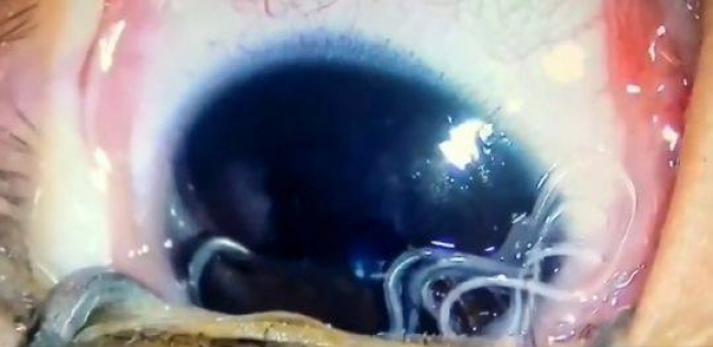 استخراج 11 نوع من الديدان من عين طفل صيني