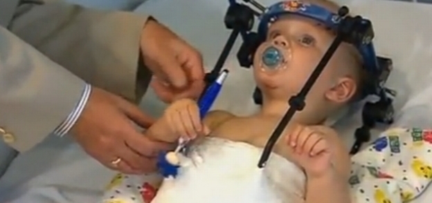 بالصور| جراحون يعيدون رأس طفل مفصول إلى جسده
