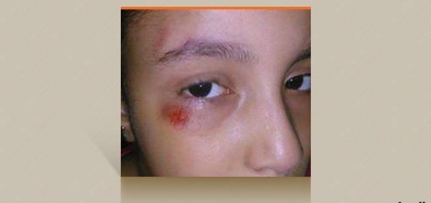 إصابة طالبة في عيناها بكدمات