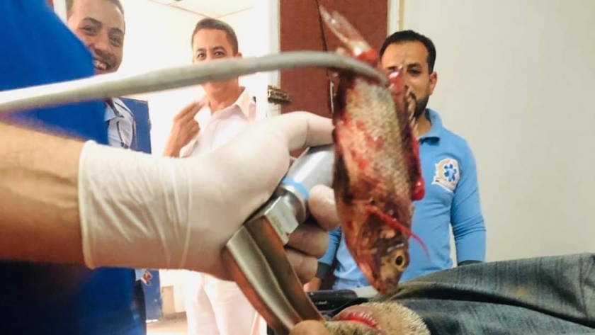 استخراج سمكة حية من قصبة مزارع الهوائية بمستشفى بني سويف التخصصي