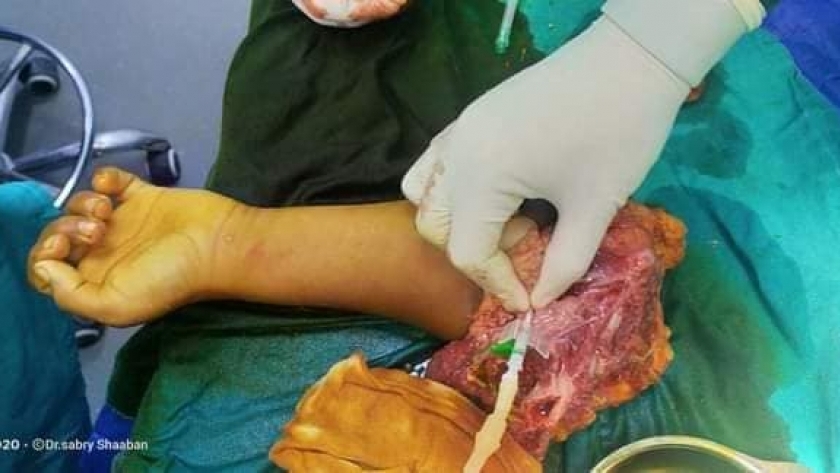 جانب من عملية الطفل لإعادة ذراعه المبتورة بمستشفى مطروح العام