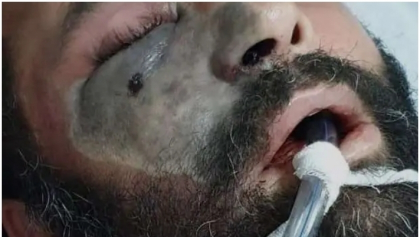 صورة من موقع العربية عن أحد المصابين بمرض الفطر الأسود