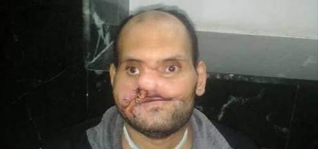 رمضان عبدالعزيز مصاب بخرطوش في الوجه