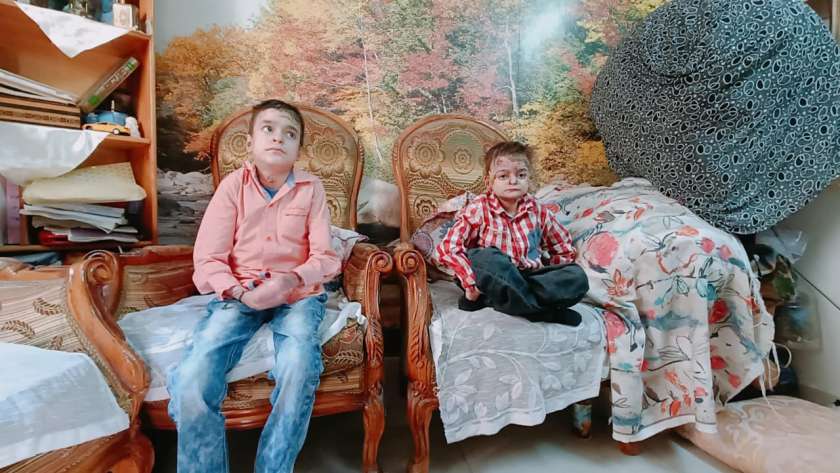 الشقيقان أحمد وعبدالله المصابان بمرض نادر
