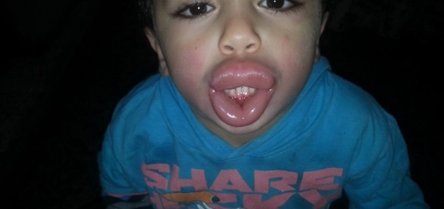 الطفل المُصاب بتورم بسبب كيش مقرمشات فى كفر الشيخ