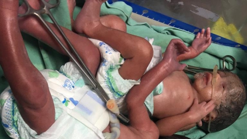 ولادة 10 تؤام في مستشفى أرمنت بالأقصر