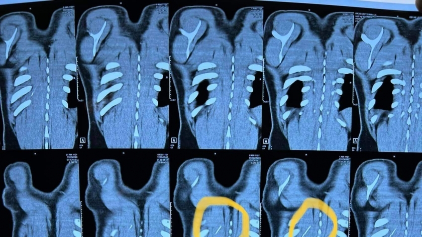 أشعة توضح وجود إبرة في ظهر مريض