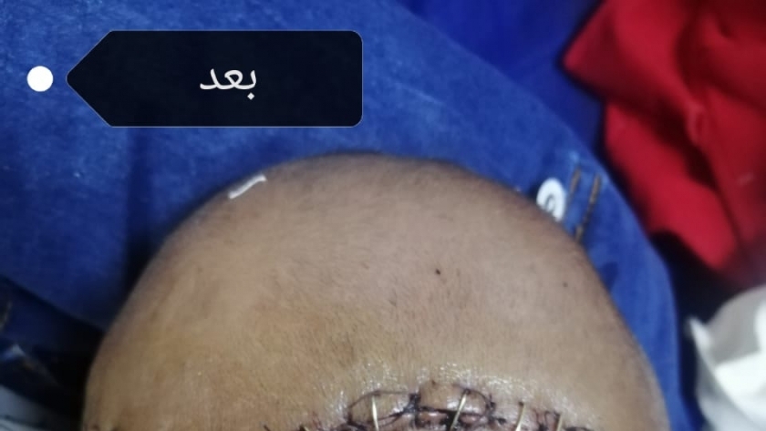 "مستشفي سوهاج الجامعي" تجري جراحة بمخ طفل لحمايته من فقدان البصر