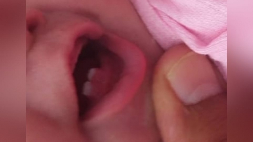 ولادة طفل بأسنان في سيناء