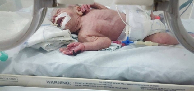 الطفل المصاب بحرق في يده  نتيجة خطأ بمستشفى بركة السبع