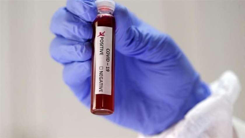 دراسة تقول أن فصيلة الدم «A» أكثر عرضة للإصابة بكورونا