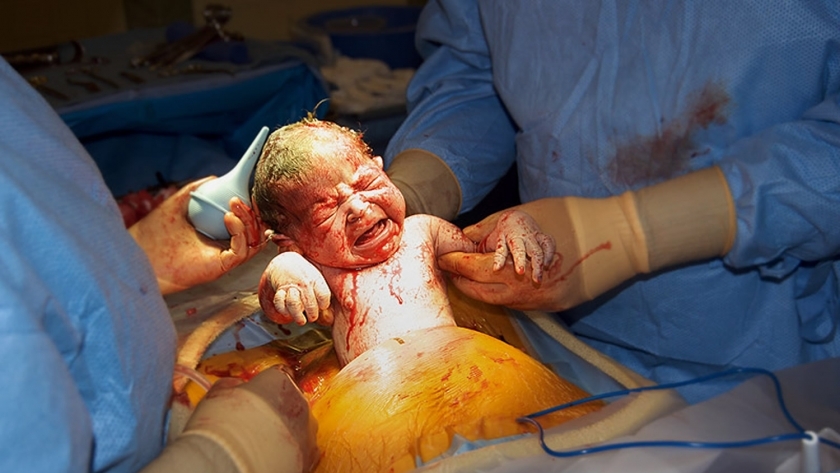 جراحة الولادة القيصرية