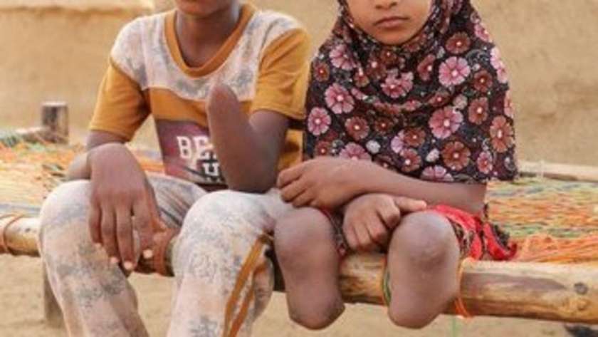 طفلة بتر ساقاها في تعز بسبب ألغام الحوثي