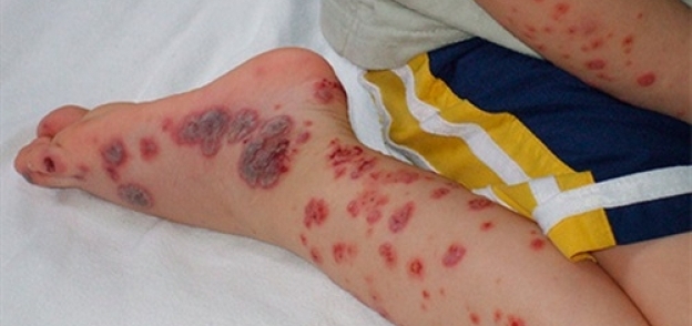 178 إصابة بفيروس حمى الضنك خلال 24 ساعة في إقليم بباكستان