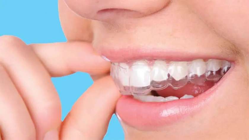 تركيبات الأسنان- تعبيرية