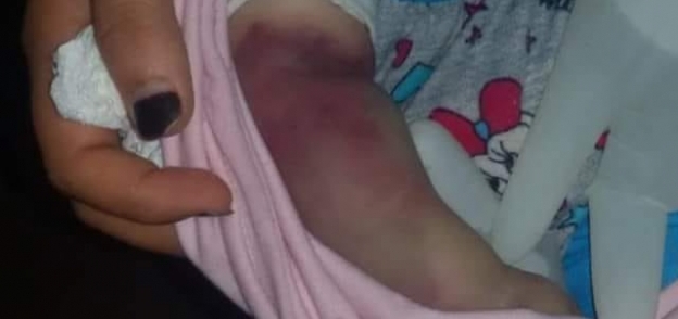 خطأ طبي بمستشفى تلا العام  يتسبب في بتر ذراع طفلة رضيعة