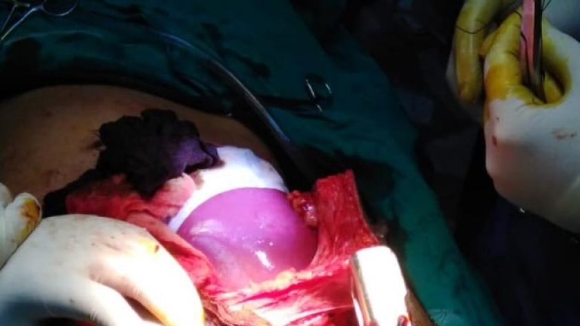 إنقاذ طفل من الموت بمستشفي طنطا الجامعي باستخراج سيخ حديدي