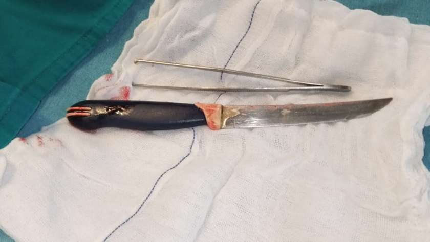 سكين مطيخ في معدة مريض