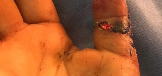 جراحة ميكرو سكوبية ناجحة لإعادة توصيل أصبع مبتور باليد بمستشفيات جامعة المنوفية