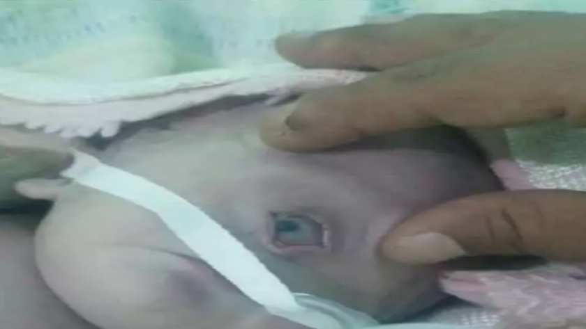 ولادة طفل يمني بعين واحدة