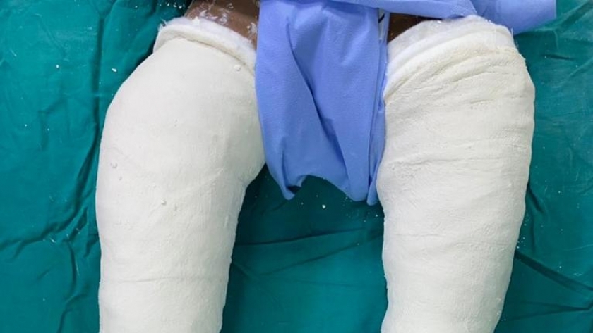 جراحة نادرة.. تقويم اعوجاج ساقي طفلة 6 سنوات بـ«مستشفي طنطا التعليمى»