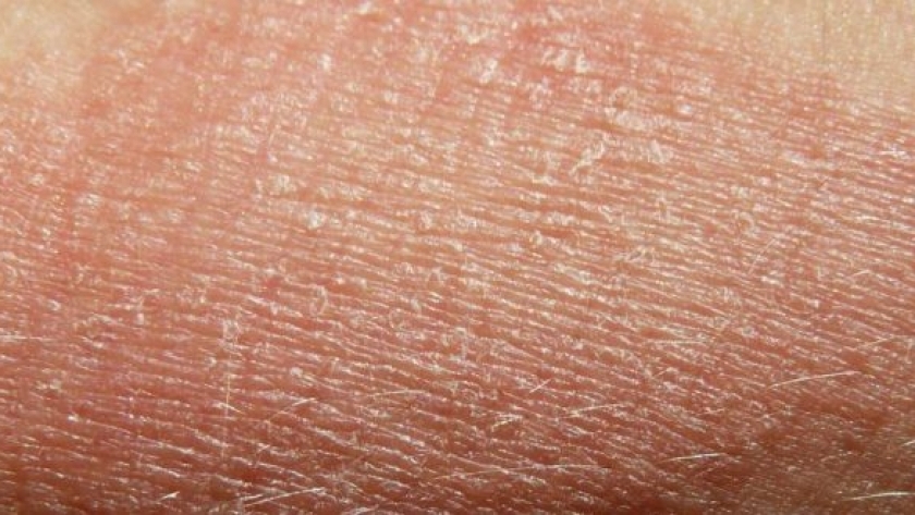 مرض جفاف الجلد