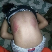 اثار الاعتداءات على طفلة بالدار