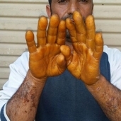 مرض جلدي يصيب 7 عمال في الشرقية.. والكشف الطبي يعجز عن التشخيص