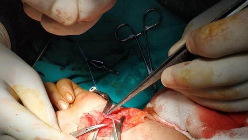 الرعاية الصحية : نجاح  جراحة لترميم تشوه عظام الوجه والفكي ببورسعيد