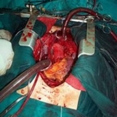 بالصور| إجراء جراحة قلب مفتوح لتغيير الشريان الأورطي لأول مرة بالفيوم