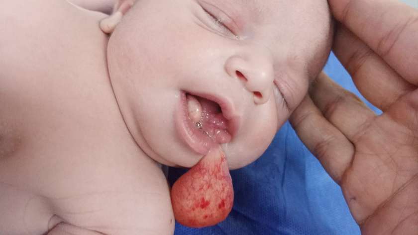 طفلة مولودة تعانى من ورم بالفم خلال اجراء عمنلية لها في مستشفى مطروح العام