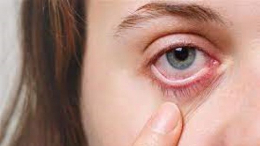 جفاف العين من الأمراض الشائعة في فصل الشتاء