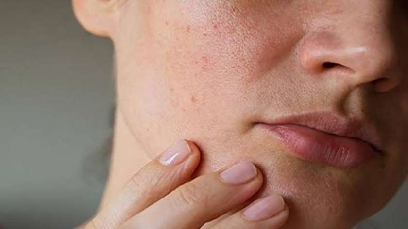 6 نصائح من صحة الشرقية لمنع جفاف الجلد في فصل الشتاء