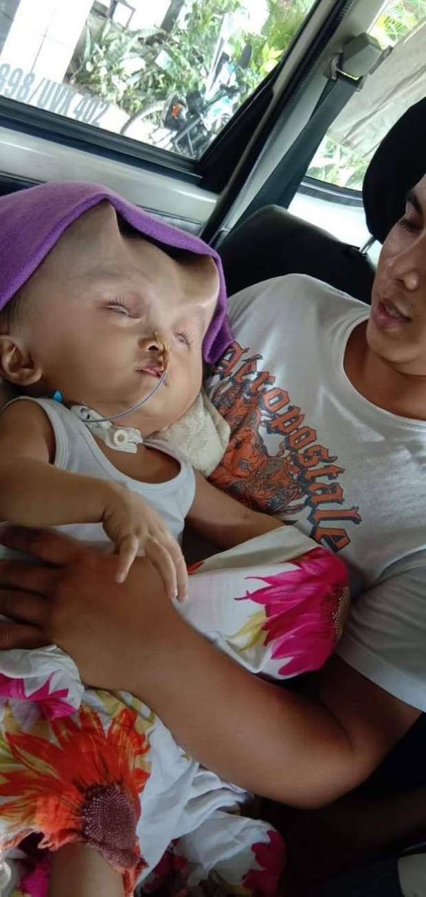 حالة نادرة لرضيع في الفلبين.. رأسه بها "قرون الشيطان"