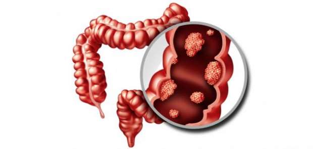3 علامات تظهر في الصباح تدل على الإصابة بسرطان القولون.. راقبها بحرص - التقرير