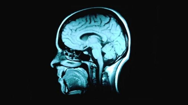  دراسة: حجم المخ يعتبر مؤشرا على الإصابة باضطرابات الطعام
