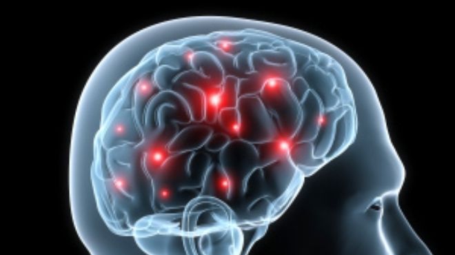 نقص الحديد عامل خطورة للإصابة بالسكتة الدماغية