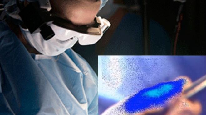 إبتكار نظارات تساعد الجراحين في تمييز خلايا السرطان 