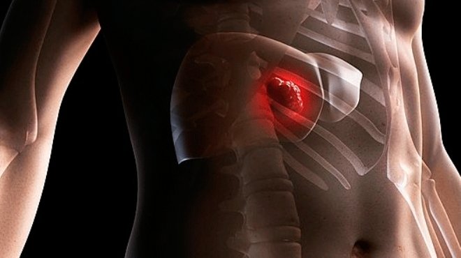الكشف المبكر يقضى على الإصابة بـ«تليف الكبد» قطعياً