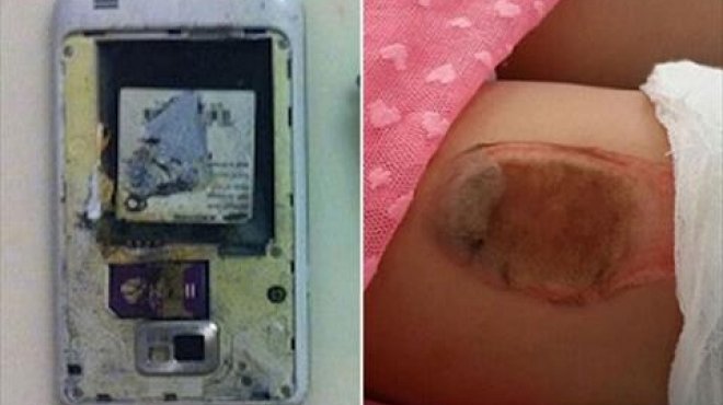 بالصور| انفجار هاتف في جيب كازاخستانية واشتعال النيران في جسدها