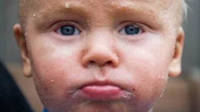 بالصور| طفل يعاني من مرض نادر يحول بشرته إلى جلد سمكة