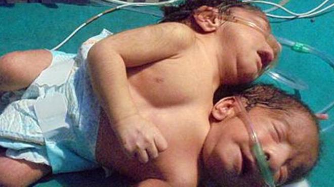 طفل هندي برأسين.. حالة جديدة تحير الأطباء