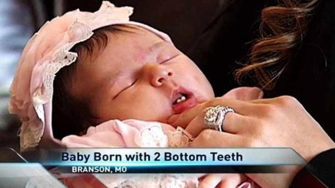 سيدة أمريكية تلد طفلة بأسنان أمامية