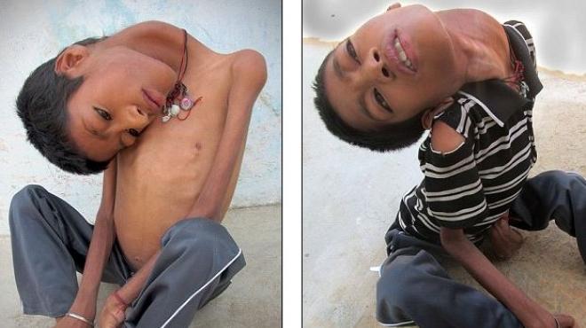 بالصور| طفل يعاني من مرض نادر عجز 50 طبيبا حول العالم عن تشخيصه