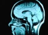  دراسة: حجم المخ يعتبر مؤشرا على الإصابة باضطرابات الطعام