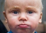 بالصور| طفل يعاني من مرض نادر يحول بشرته إلى جلد سمكة
