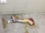 ساق مبتورة بمستشفى الإسكندرية