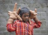 بالصور| طفل هندي يمتلك كفين أكبر من رأسه