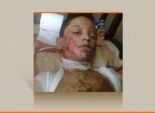  مأساة الطفل مصطفى.. 3 بلطجية يشعلون النيران في جسده بعد فشلهم في التعدي عليه جنسيا